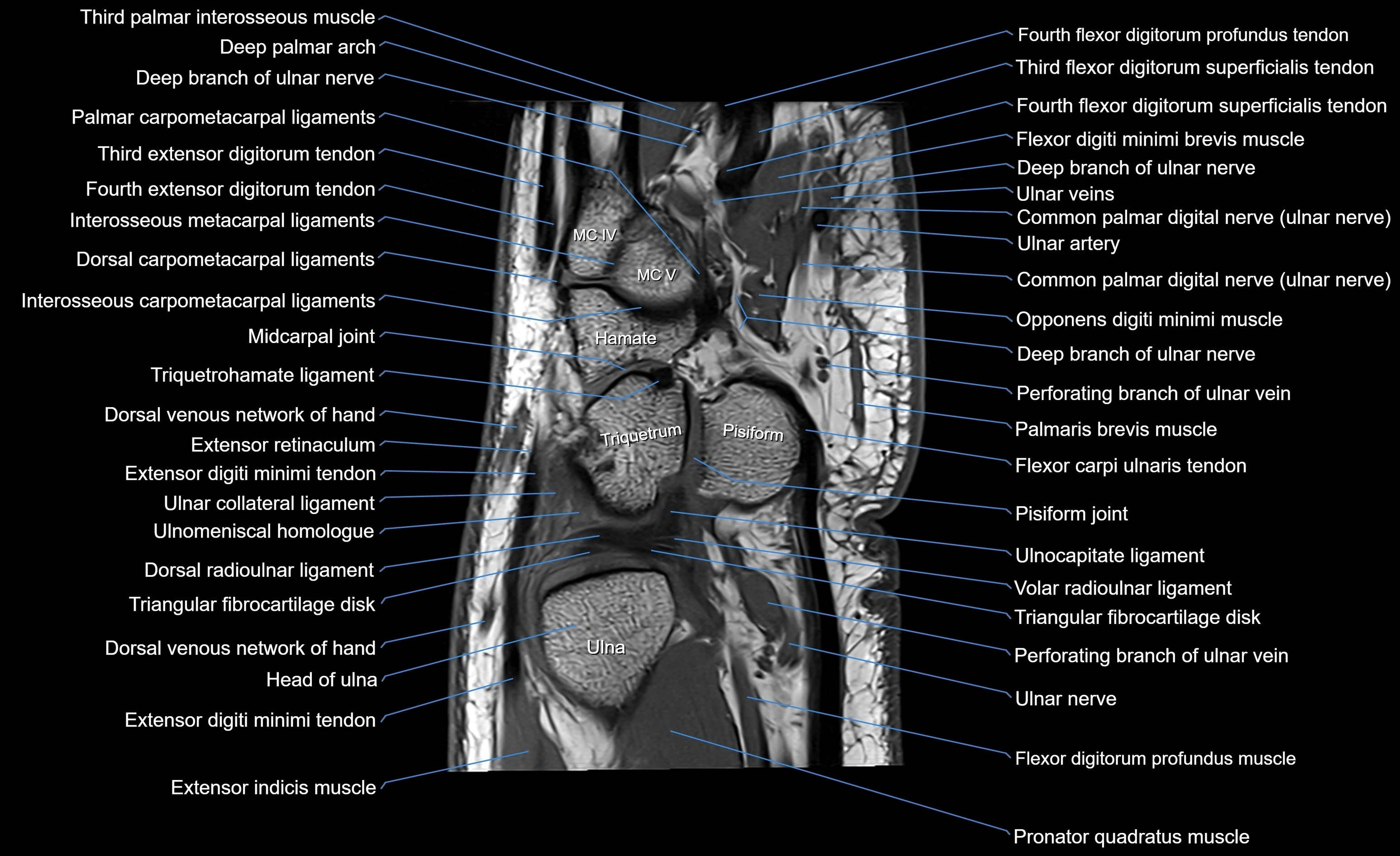 MRI wrist sagittal cross sectional anatomy 3T  radiology  image-img-00001-00019.webp
